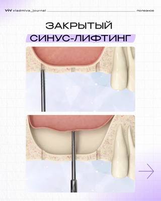 Закрытый синус-лифтинг: решение для одномоментной имплантации.
